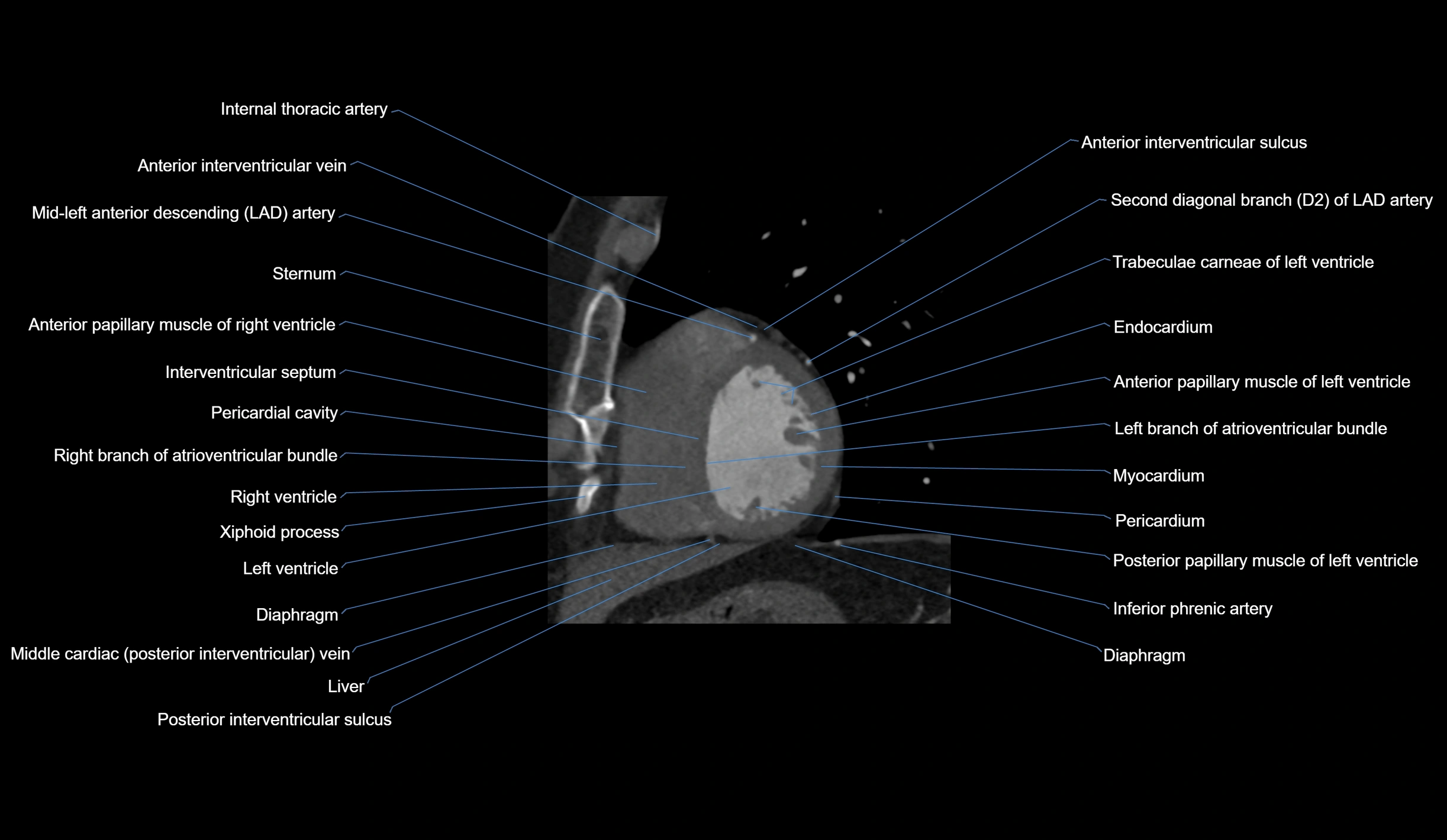 CT heart (coronary angiogram) short axis view  cross sectional anatomy labelled radiology image-00037.webp